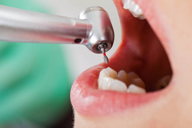 Best Emergency Wisdom Teeth Removal in Tillson, NY